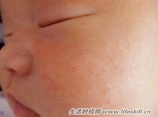 消除宝宝的痱子有妙招